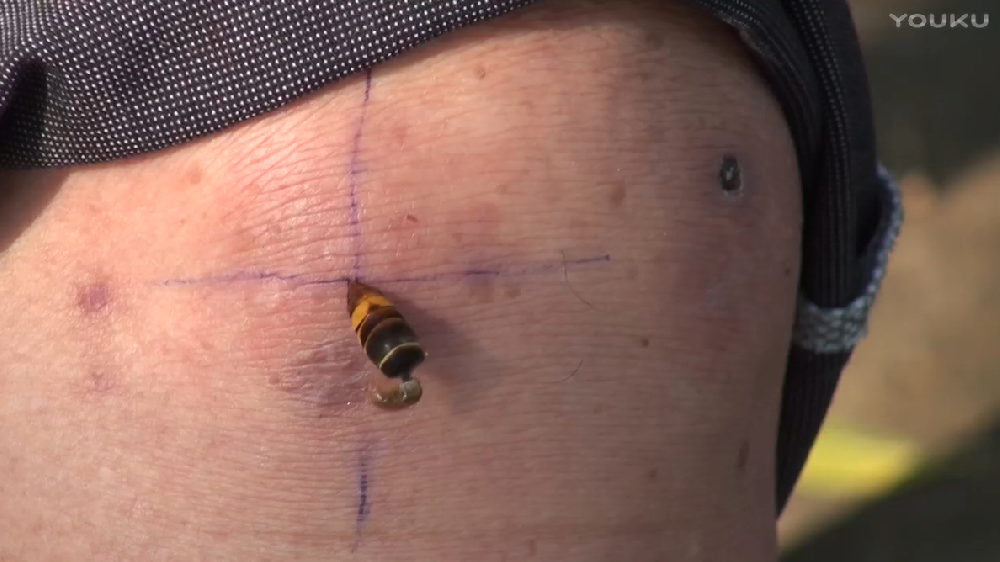 胡蜂蜂疗：蜂疗保健网胡蜂蜂针蜇刺现场视频